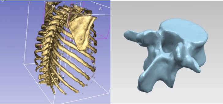 progetto spine solution